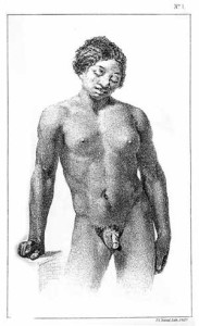 Illustration from Dr. John Neill, "Case of Hermaphroditism," Summary of the Transactions of the College of Physicians of Philadelphia 1 (1850): 114. Courtesy of the Yale Medical Library.